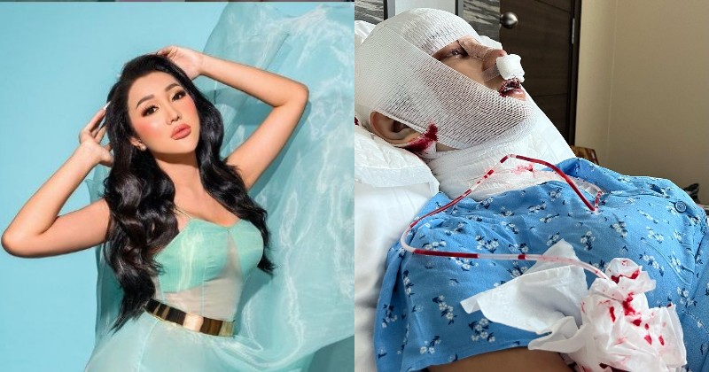 Operasi Lagi Biar Makin Cantik, Lucinta Luna Hilangkan Jakun di Leher